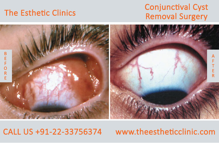 Conjuctival Cyst Removal Surgery, Eye Tumor Treatment before after photos in mumbai india